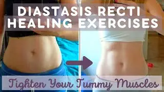 Diastasis Recti Healing Exercises Part 1 (TIGHTEN TUMMY MUSCLES AFTER BABY)