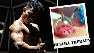 My First Hijama Wet Cupping Therapy | Full Body Detox Formula