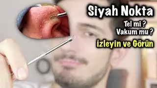 Siyah Noktalara DOKTOR YÖNTEMİ !