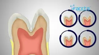 Pit and Fissure Sealant to prevent tooth cavity.