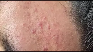 Acne treatment for Hoang (P.4) #HoangMySpa114