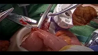 Total Pelvic Resection for Locally Advanced Rectal Cancer after Neoadjuvant Therapy Failure