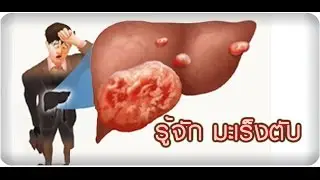 โรค #มะเร็งตับ liver cancer  อาการ การรักษามะเร็งตับ ถ้ารู้ก่อนมีโอกาสรักษาหายได้