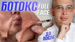 КАК КОЛОТЬ БОТОКС ПРАВИЛЬНО | FULL FACE ! НЕ колите БОТОКС пока не посмотрите это видео! 