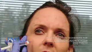 IFAAS Exclusive Technique: Filler Injection for Cheekbone Augmentation