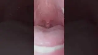 Uvula and Tonsils