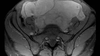 Benign metastasizing leiomyoma