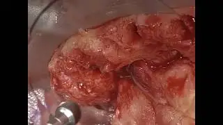 Fully Guided Full Arch All on 4 Bone Reduction
