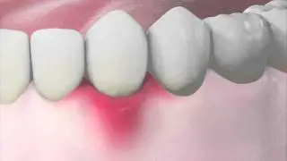 The stages of periodontal disease