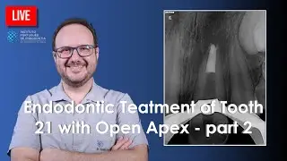 Endodontic Teatment of Tooth 21 with Open Apex - part 2