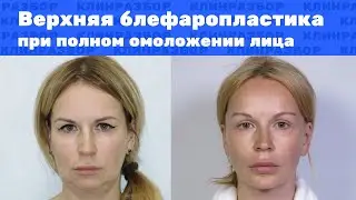 Операция: верхняя блефаропластика при тотальной подтяжке лица