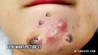 Goldmine Blackhead Extractions; What Do You Prefer?