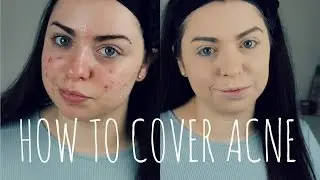 HOW TO COVER ACNE | Acne Coverage Foundation Routine