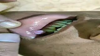 retention cyst (lower lip)