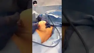 What happens when implants are removed  