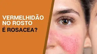 Rosto vermelho: Vermelhidão no rosto, é rosácea?