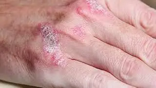 КАК ВЫГНАТЬ ГРИБЫ И ПЛЕСЕНЬ ИЗ ОРГАНИЗМА