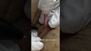 Глубокое бикини клиторальная область, электроэпиляция обучение, аппарат микротерм, 4 off