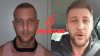 hair transplant turkey 6 months update
