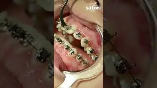 Самолигирующие брекеты с замками 