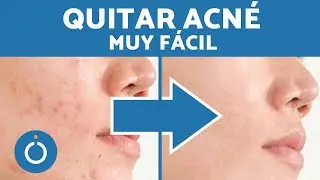 Cómo QUITAR GRANOS con PHOTOSHOP ✔️ Suprimir ACNÉ de FOTO