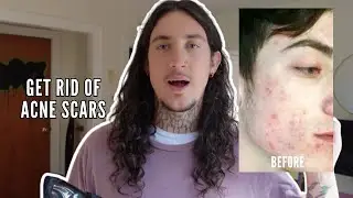 How To Get Rid of Acne Scars AT HOME