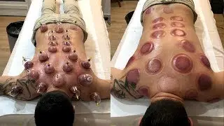 ⚕️LES VENTOUSES CHINOISES, ÇA FAIT MAL ?