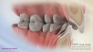 Deep Bite With Excessive Overjet