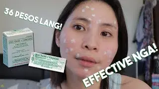 How To Dry Pimples in 3 Days | Affordable Acne Treatment