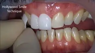 Hollywood Smile _ New Year, New Smile