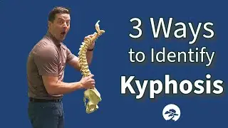 3 Ways to Identify Kyphosis