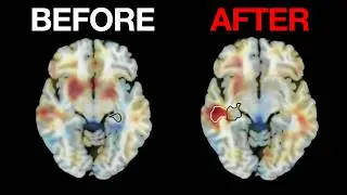 Long-Term Effect of Electroconvulsive Therapy (ECT) on the Brain