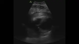 Hemopericardium