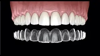 Invisalign: Unveiling the Hidden Risks 