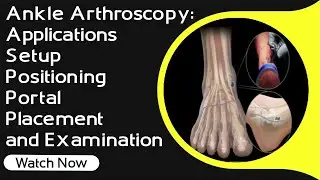 Ankle Arthroscopy: Applications, Setup, Positioning, Portal Placement, and Examination