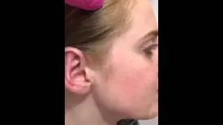 dr edgar   Уши на й день после операции  days after Otoplasty