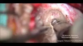 Delicot in an Acoustic Neuroma Resection, Retrosigmoid Approach Part 2