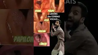Lesões das CORDAS VOCAIS que só saem com CIRURGIA