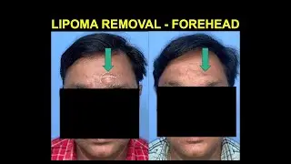 Lipoma I Lipoma removal I lipoma over forehead I Lipoma removal in dehradun 