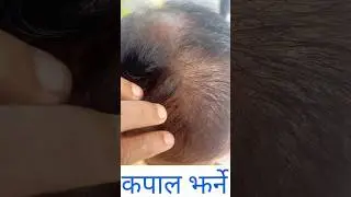 कपाल झर्ने समस्या #health #shorts #skincare