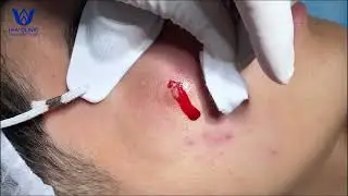 NẶN MỤN NHỌT VIÊM TỤ CẦU VÙNG MÁ TẠI PHÒNG KHÁM DA LIỄU HHV CLINIC.