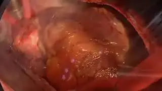 операция сердце yurak ochiq operatsiyasi