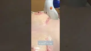 How to treat breast reduction scars using lasers by Dr. Hooman Khorasani