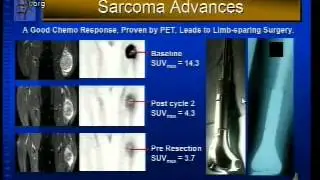 Tumor Tumors and Related Conditions