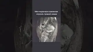 Местнораспространенная опухоль прямой кишки