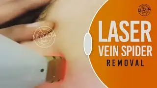 Spider Veins Treatment | Laser Treatment