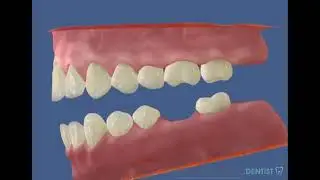 Неполный зубной ряд неминуемо ведет к  изменению прикуса и дальнейшей потере зубов.