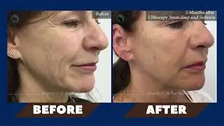 Dr. Shelton Discusses Sofwave and Its Benefits
