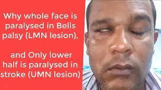 Facial palsy LMN vs UMN lesion Anatomical basis