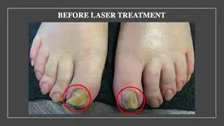 Fungal Nail Transformation With Laser Treatment